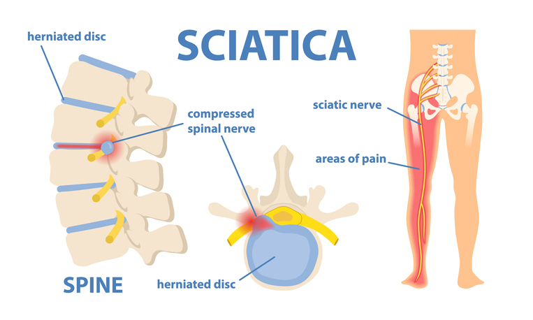Infographic explaining sciatica