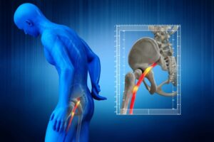 Sciatica Pain graphic