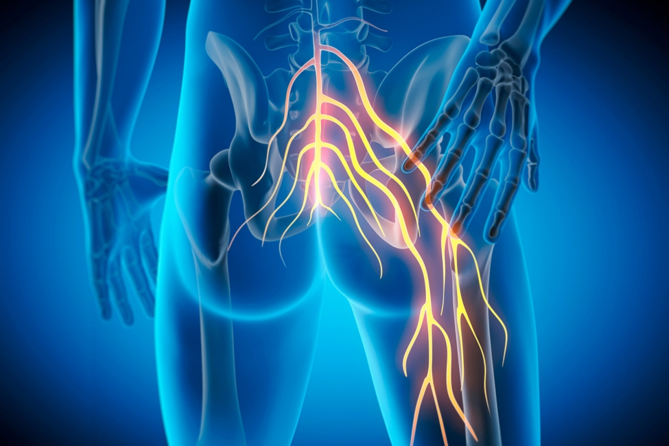 graphic of sciatica pain