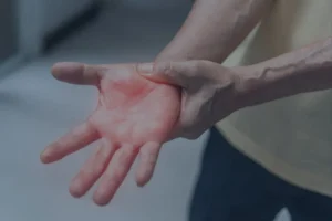 Peripheral Neuropathy on hand