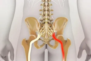 Bulging Disc vs Herniated Disc