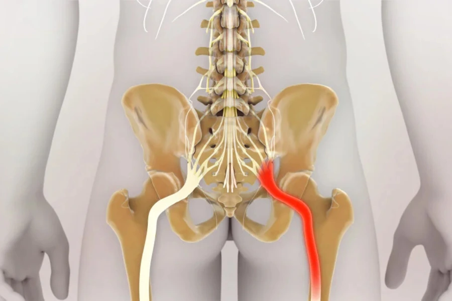 Bulging Disc vs Herniated Disc
