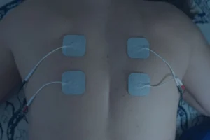 spinal cord stimulator trial example