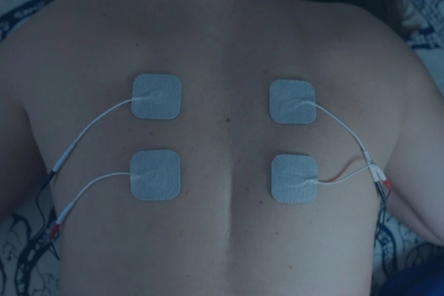 spinal cord stimulator trial example